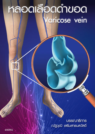 หลอดเลือดดำขอด Varicose vein