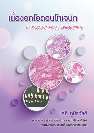 เนื้องอกโอดอนโทเจนิก (Odontogenic tumours)