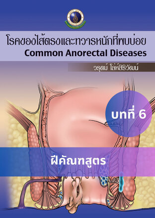 โรคของไส้ตรงและทวารหนักที่พบบ่อย บทที่ 6 ฝีคัณฑสูตร