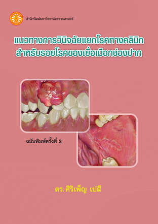 แนวทางการวินิจฉัยแยกโรคทางคลินิก สำหรับรอยโรคของเยื่อเมือกช่องปาก  ฉพ.2